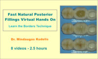 Fast Natural Posterior Fillings Virtual Hands On