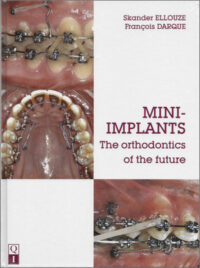 MINI-IMPLANTS: The Orthodontics of the Future (Scanned Copy)