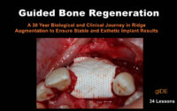 Guided Bone Regeneration: A 30 year Biological and Clinical Journey in Ridge Augmentation