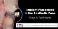 Implant Placement in the Aesthetic Zone: Steps & Techniques