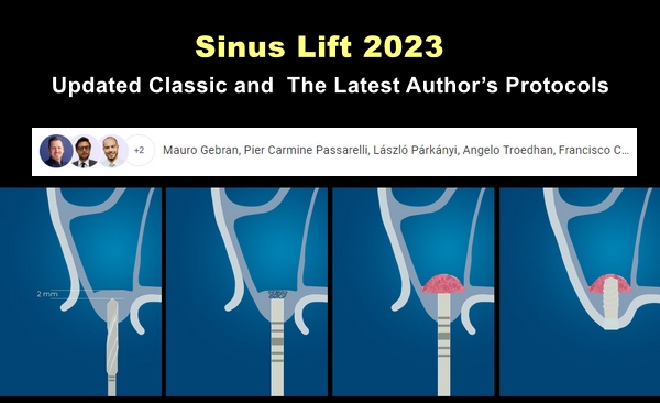 Sinus Lift 2023, Updated Classic and the Latest Author’s Protocols