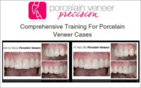 Porcelain Veneer Precision: Comprehensive Training for Porcelain Veneer Cases